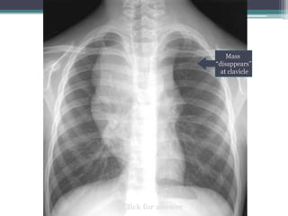 Mass
“disappears”
at clavicle
Click for answer
 