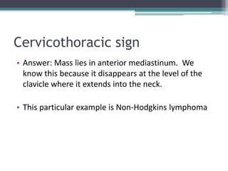 Cervicothoracic sign
• Answer: Mass lies in anterior mediastinum. We
know this because it disappears at the level of the
clavicle where it extends into the neck.
• This particular example is Non-Hodgkins lymphoma
 