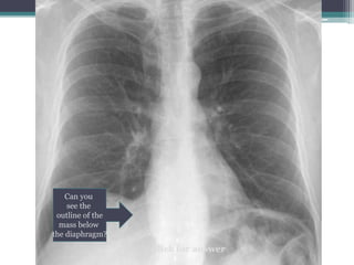Can you
see the
outline of the
mass below
the diaphragm?
Click for answer
 