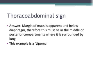 Thoracoabdominal sign
• Answer: Margin of mass is apparent and below
diaphragm, therefore this must be in the middle or
posterior compartments where it is surrounded by
lung
• This example is a ‘Lipoma’
 