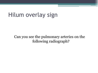 Hilum overlay sign
Can you see the pulmonary arteries on the
following radiograph?
 