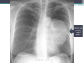 Hilum can
be seen
through
mass
Click for answer
 