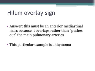 Hilum overlay sign
• Answer: this must be an anterior mediastinal
mass because it overlaps rather than “pushes
out” the main pulmonary arteries
• This particular example is a thymoma
 