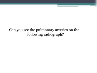 Can you see the pulmonary arteries on the
following radiograph?
 