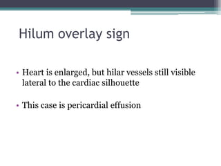 Hilum overlay sign
• Heart is enlarged, but hilar vessels still visible
lateral to the cardiac silhouette
• This case is pericardial effusion
 