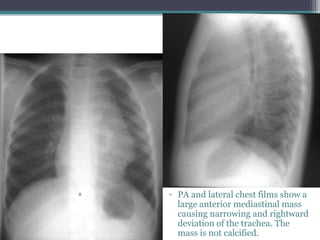 ▫ PA and lateral chest films show a
large anterior mediastinal mass
causing narrowing and rightward
deviation of the trachea. The
mass is not calcified.
 