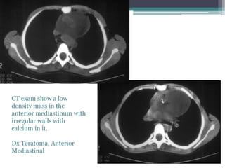 CT exam show a low
density mass in the
anterior mediastinum with
irregular walls with
calcium in it.
Dx Teratoma, Anterior
Mediastinal
 