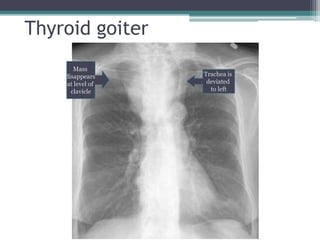 Thyroid goiter
Trachea is
deviated
to left
Mass
disappears
at level of
clavicle
 