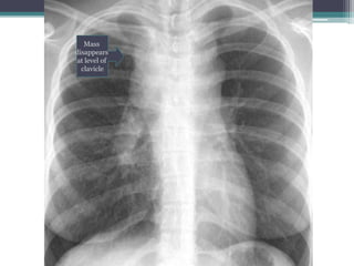 Mass
disappears
at level of
clavicle
 