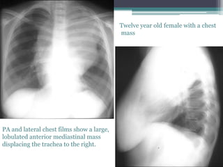 PA and lateral chest films show a large,
lobulated anterior mediastinal mass
displacing the trachea to the right.
Twelve year old female with a chest
mass
 