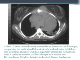 A chest CT exam shows the mass to extend from the neck to the diaphragm,
compressing the tracheal and left mainstem bronchus leading to left lower
lobe atelectasis. The chest wall mass is partially eroding the sternum and
there is periosteal reaction. Axillary adenopathy is present also.
Dx:Lymphoma, Hodgkin, Anterior Mediastinal, Sternal Involvement
 