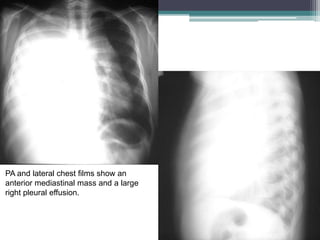 PA and lateral chest films show an
anterior mediastinal mass and a large
right pleural effusion.
 