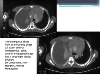 Two contiguous slices
from an enhanced chest
CT exam show a
homogenous, solid,
anterior mediastinal mass
and a large right pleural
effusion.
Dx-Lymphoma, Non-
Hodgkin, Anterior
Mediastinal
 