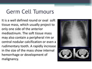Germ Cell Tumours
It is a well defined round or oval soft
tissue mass, which usually project to
only one side of the anterior
mediastinum. The soft tissue mass
may also contain a peripheral rim or
central nodular calcification or even a
rudimentary tooth. A rapidly increase
in the size of the mass show internal
hemorrhage or development of
malignancy.
 