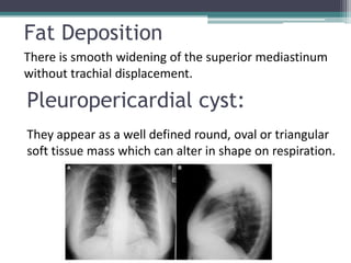 Fat Deposition
There is smooth widening of the superior mediastinum
without trachial displacement.
Pleuropericardial cyst:
They appear as a well defined round, oval or triangular
soft tissue mass which can alter in shape on respiration.
 