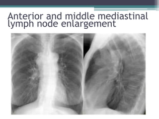 Anterior and middle mediastinal
lymph node enlargement
 