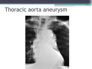 Thoracic aorta aneurysm
 