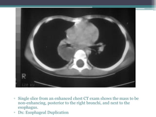 ▫ Single slice from an enhanced chest CT exam shows the mass to be
non-enhancing, posterior to the right bronchi, and next to the
esophagus.
▫ Dx: Esophageal Duplication
 