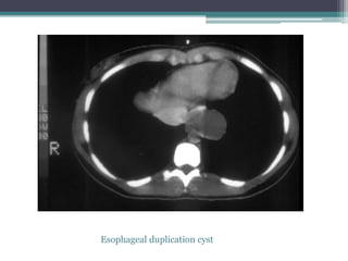 Esophageal duplication cyst
 