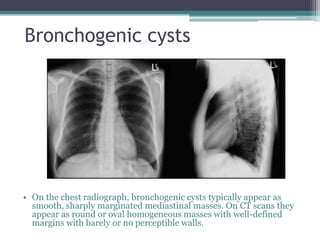 Bronchogenic cysts
• On the chest radiograph, bronchogenic cysts typically appear as
smooth, sharply marginated mediastinal masses. On CT scans they
appear as round or oval homogeneous masses with well-defined
margins with barely or no perceptible walls.
 
