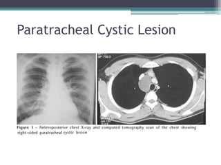 Paratracheal Cystic Lesion
 