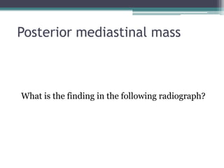 Posterior mediastinal mass
What is the finding in the following radiograph?
 
