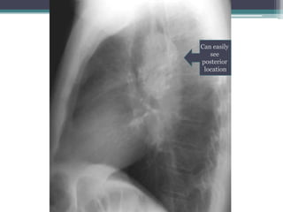 Can easily
see
posterior
location
 