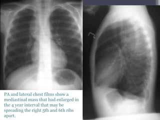 PA and lateral chest films show a
mediastinal mass that had enlarged in
the 4 year interval that may be
spreading the right 5th and 6th ribs
apart.
 