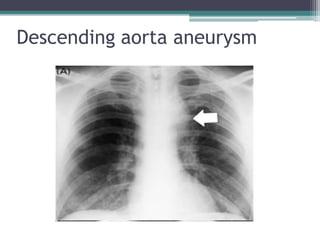 Descending aorta aneurysm
 