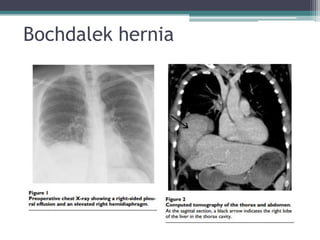 Bochdalek hernia
 