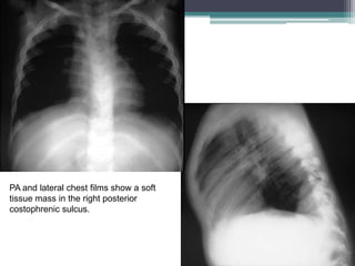 PA and lateral chest films show a soft
tissue mass in the right posterior
costophrenic sulcus.
 