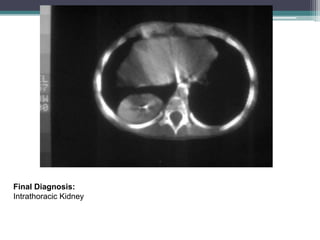 Final Diagnosis:
Intrathoracic Kidney
 