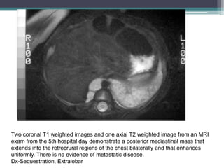 Two coronal T1 weighted images and one axial T2 weighted image from an MRI
exam from the 5th hospital day demonstrate a posterior mediastinal mass that
extends into the retrocrural regions of the chest bilaterally and that enhances
uniformly. There is no evidence of metastatic disease.
Dx-Sequestration, Extralobar
 