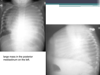 large mass in the posterior
mediastinum on the left.
 