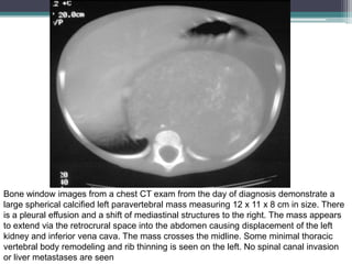 Bone window images from a chest CT exam from the day of diagnosis demonstrate a
large spherical calcified left paravertebral mass measuring 12 x 11 x 8 cm in size. There
is a pleural effusion and a shift of mediastinal structures to the right. The mass appears
to extend via the retrocrural space into the abdomen causing displacement of the left
kidney and inferior vena cava. The mass crosses the midline. Some minimal thoracic
vertebral body remodeling and rib thinning is seen on the left. No spinal canal invasion
or liver metastases are seen
 
