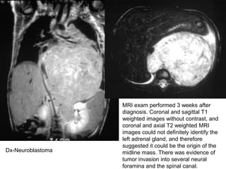 MRI exam performed 3 weeks after
diagnosis. Coronal and sagittal T1
weighted images without contrast, and
coronal and axial T2 weighted MRI
images could not definitely identify the
left adrenal gland, and therefore
suggested it could be the origin of the
midline mass. There was evidence of
tumor invasion into several neural
foramina and the spinal canal.
Dx-Neuroblastoma
 