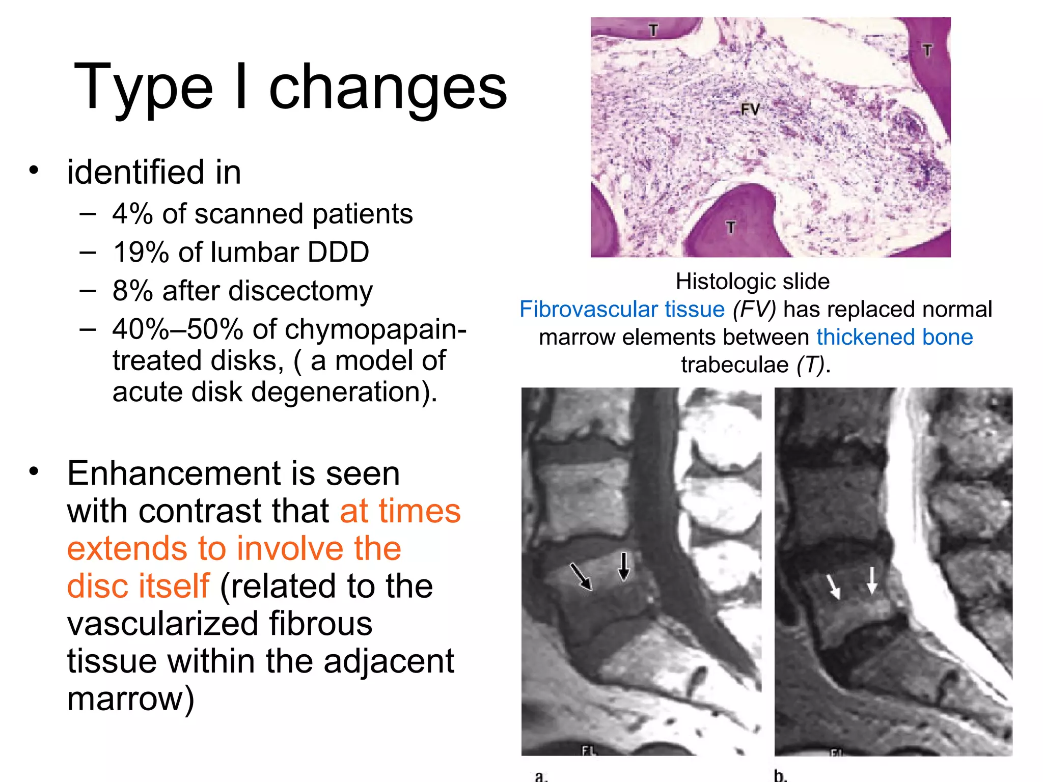 Type I changes 
• identified in 
– 4% of scanned patients 
– 19% of lumbar DDD 
– 8% after discectomy 
– 40%–50% of chymopapain-treated 
disks, ( a model of 
acute disk degeneration). 
• Enhancement is seen 
with contrast that at times 
extends to involve the 
disc itself (related to the 
vascularized fibrous 
tissue within the adjacent 
marrow) 
Histologic slide 
Fibrovascular tissue (FV) has replaced normal 
marrow elements between thickened bone 
trabeculae (T). 
 