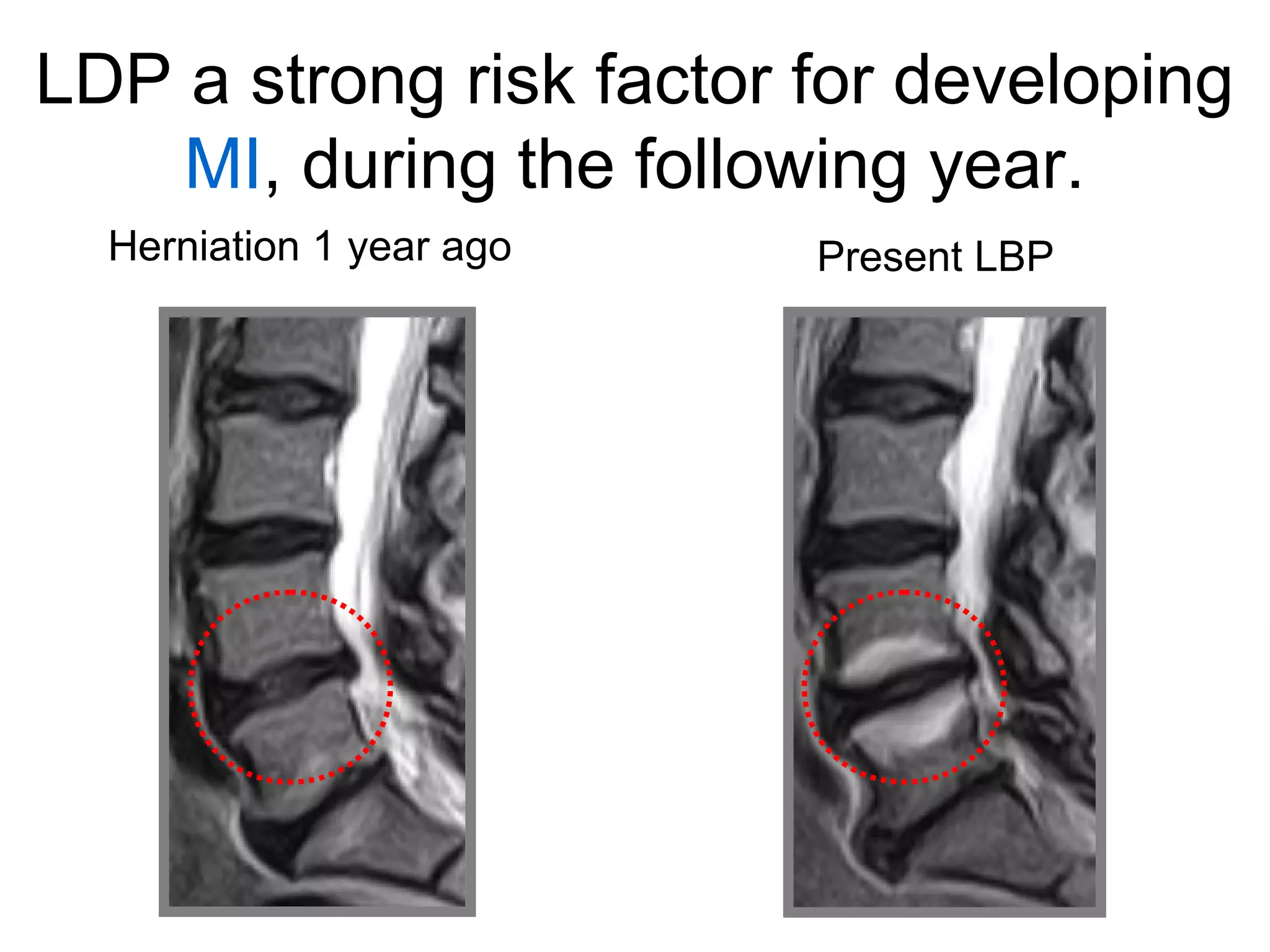 LDP a strong risk factor for developing 
MI, during the following year. 
Herniation 1 year ago Present LBP 
 