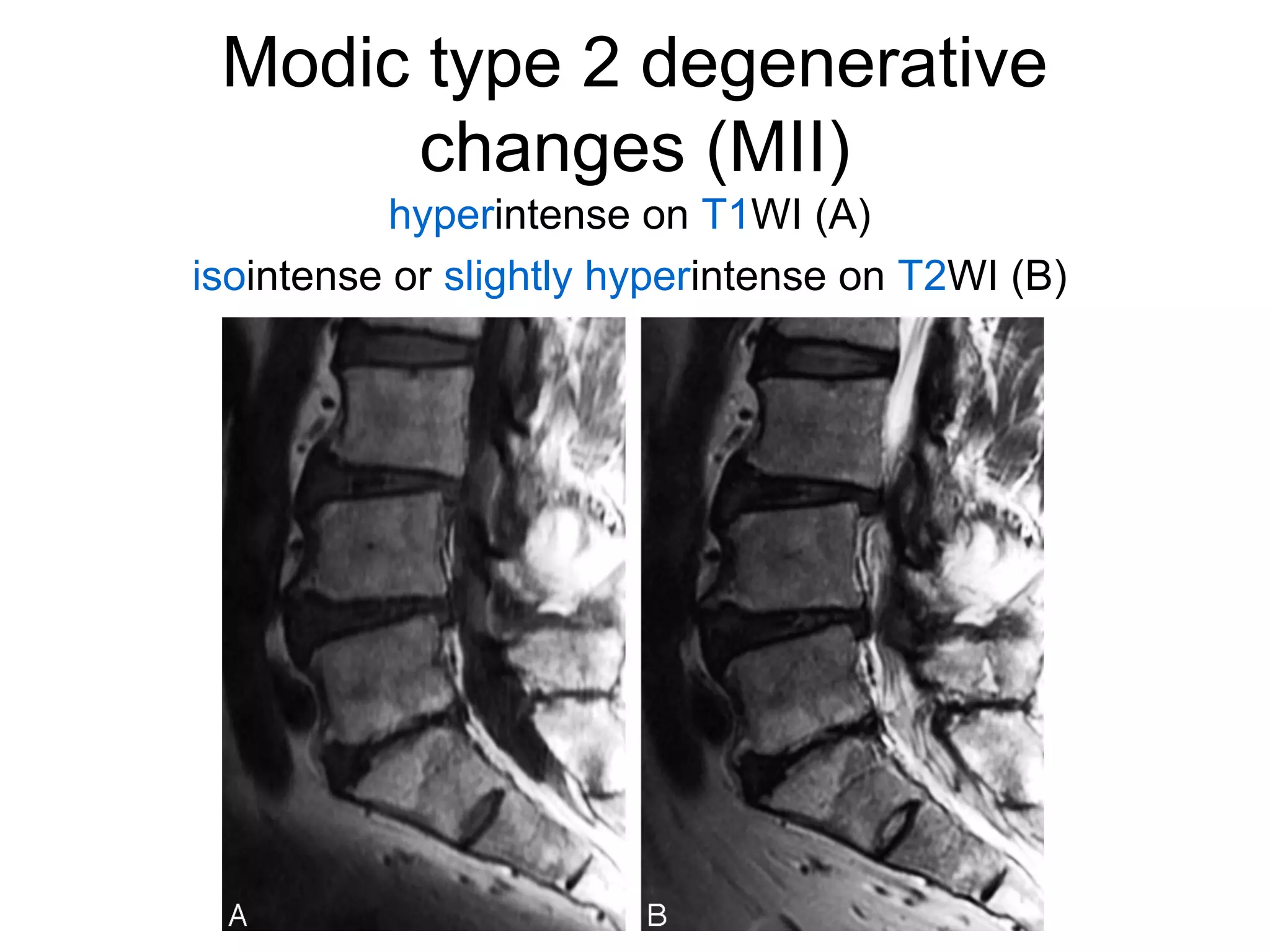 Modic type 2 degenerative 
changes (MII) 
hyperintense on T1WI (A) 
isointense or slightly hyperintense on T2WI (B) 
 