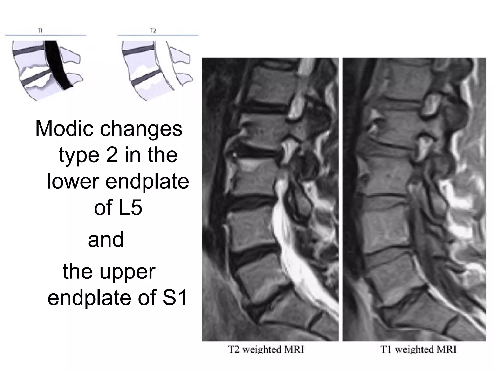 Modic changes 
type 2 in the 
lower endplate 
of L5 
and 
the upper 
endplate of S1 
 