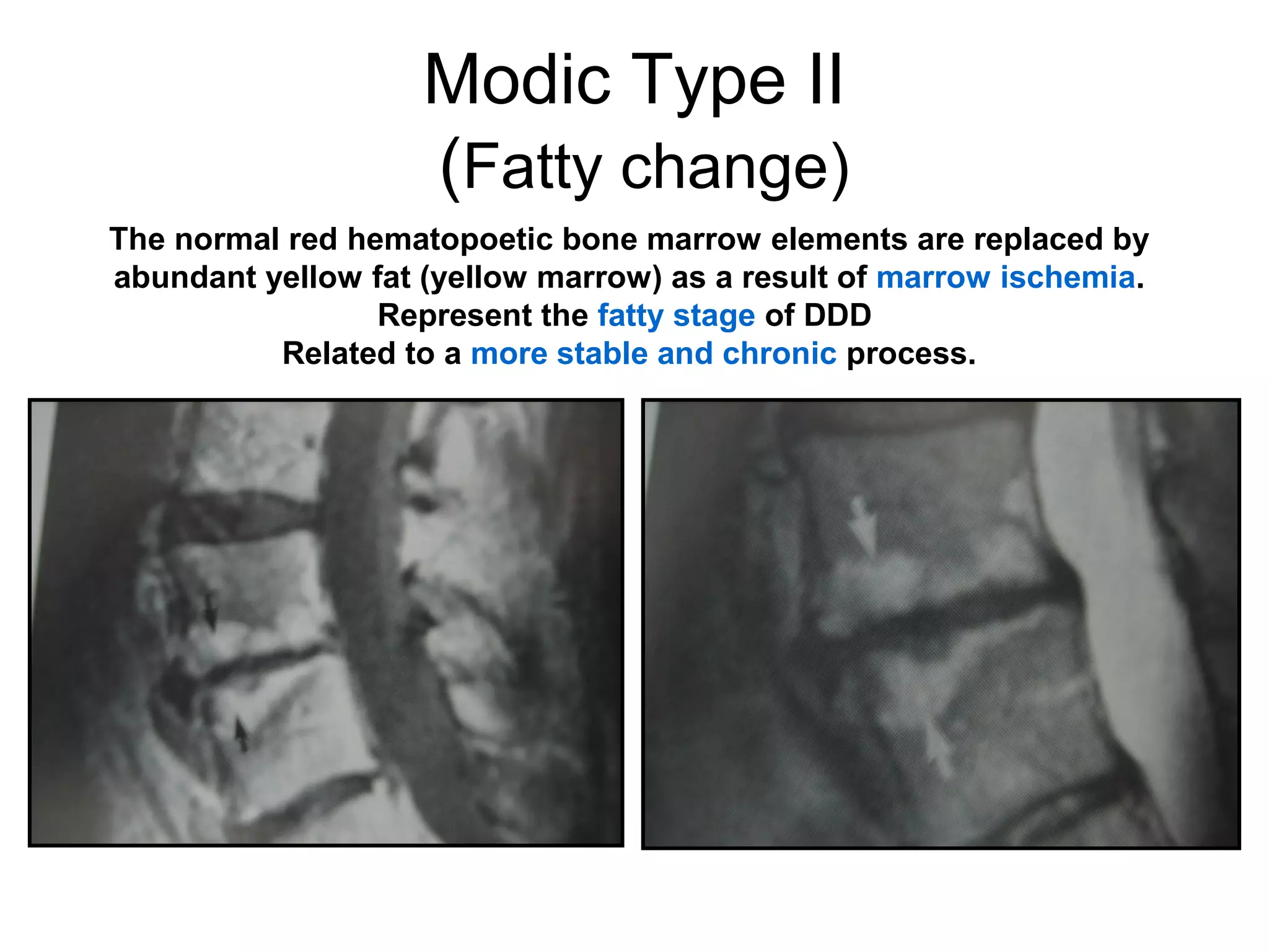 Modic Type II 
(Fatty change) 
The normal red hematopoetic bone marrow elements are replaced by 
abundant yellow fat (yellow marrow) as a result of marrow ischemia. 
Represent the fatty stage of DDD 
Related to a more stable and chronic process. 
 