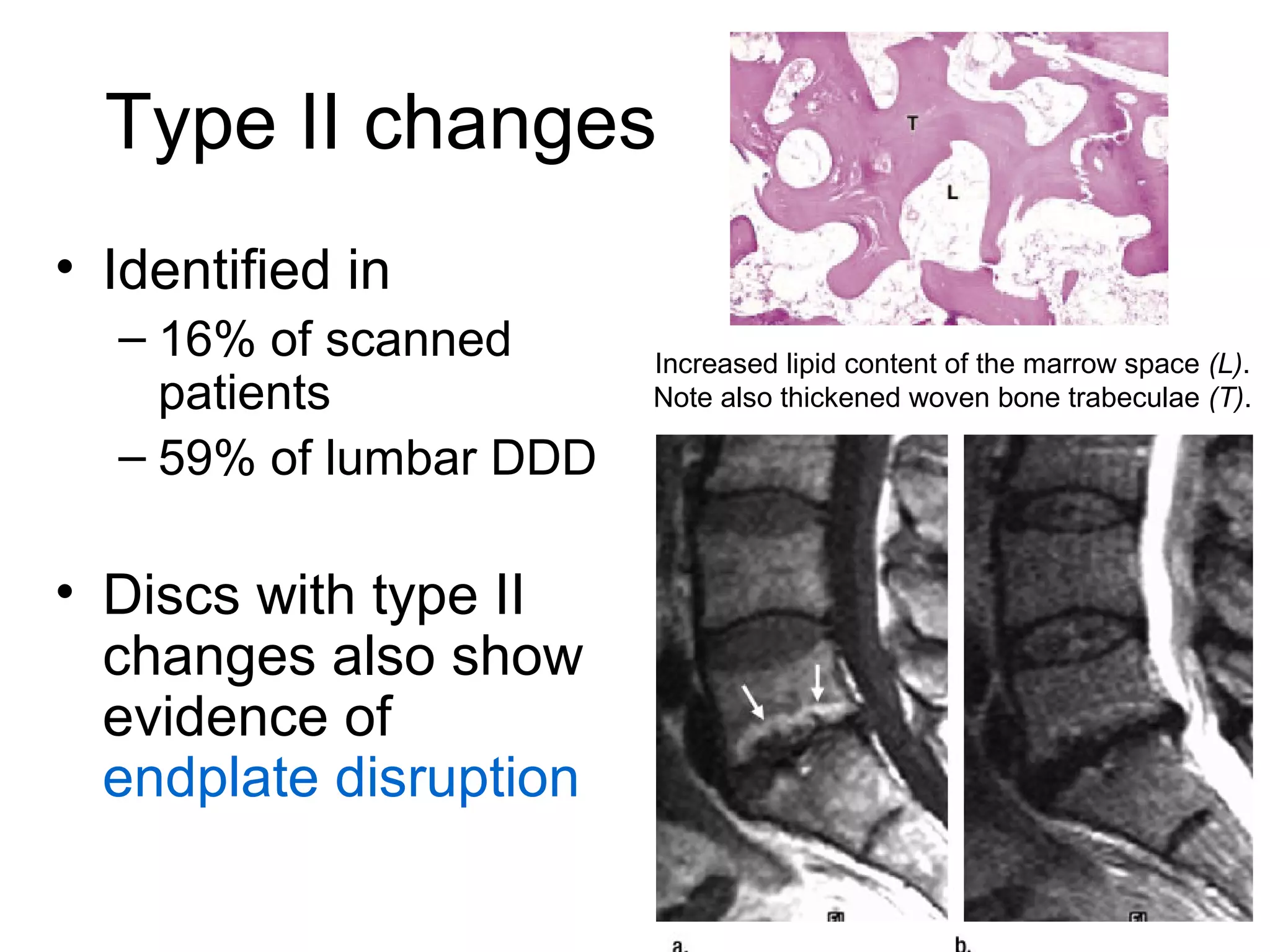 Type II changes 
• Identified in 
– 16% of scanned 
patients 
– 59% of lumbar DDD 
• Discs with type II 
changes also show 
evidence of 
endplate disruption 
Increased lipid content of the marrow space (L). 
Note also thickened woven bone trabeculae (T). 
 