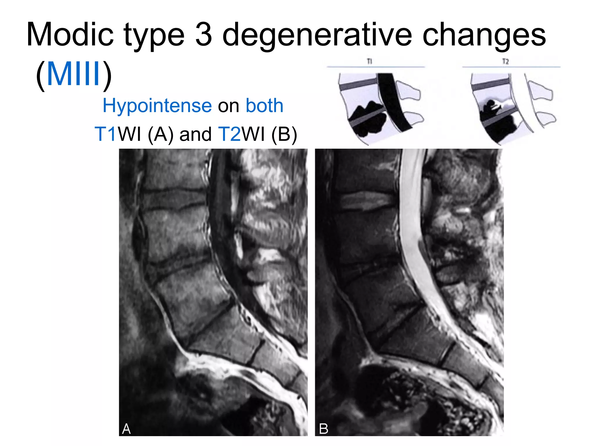Modic type 3 degenerative changes 
(MIII) 
Hypointense on both 
T1WI (A) and T2WI (B) 
 