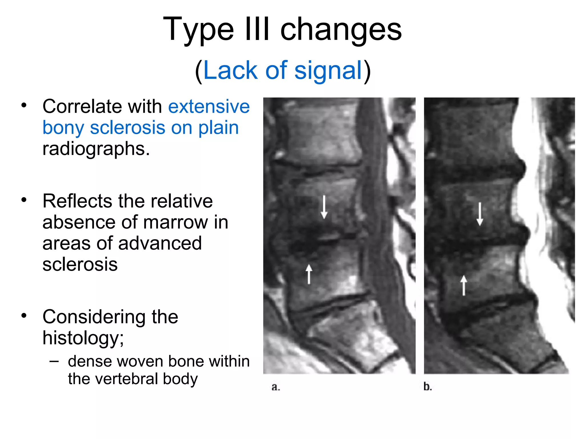 Type III changes 
(Lack of signal) 
• Correlate with extensive 
bony sclerosis on plain 
radiographs. 
• Reflects the relative 
absence of marrow in 
areas of advanced 
sclerosis 
• Considering the 
histology; 
– dense woven bone within 
the vertebral body 
 