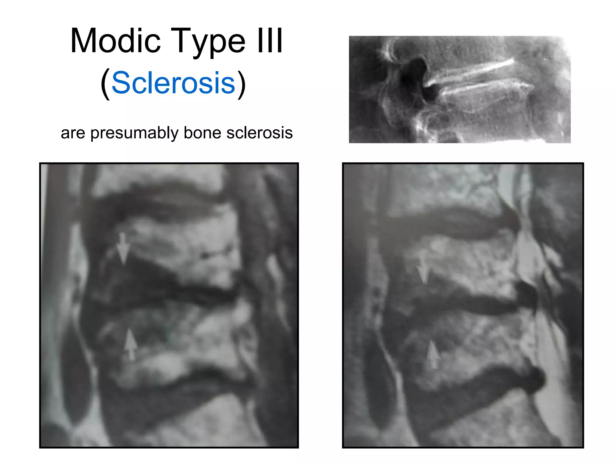 Modic Type III 
(Sclerosis) 
are presumably bone sclerosis 
 