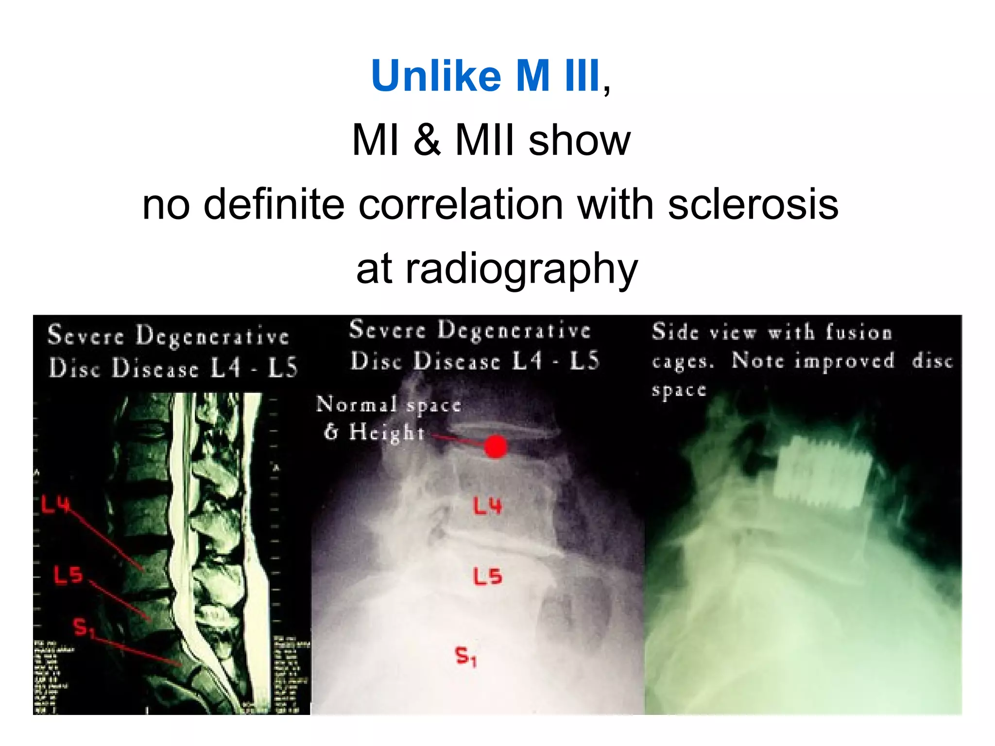 Unlike M III, 
MI & MII show 
no definite correlation with sclerosis 
at radiography 
 