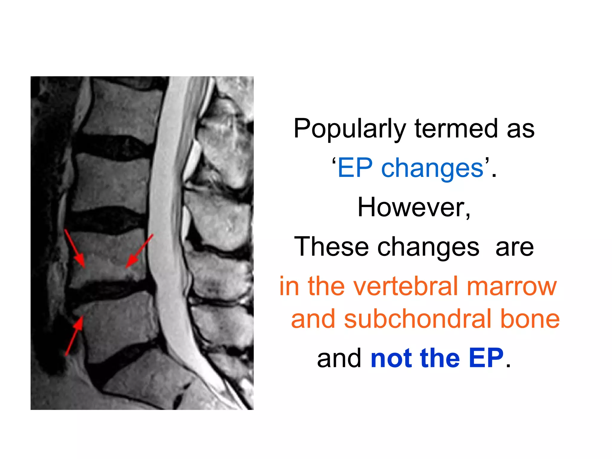 Popularly termed as 
‘EP changes’. 
However, 
These changes are 
in the vertebral marrow 
and subchondral bone 
and not the EP. 
 