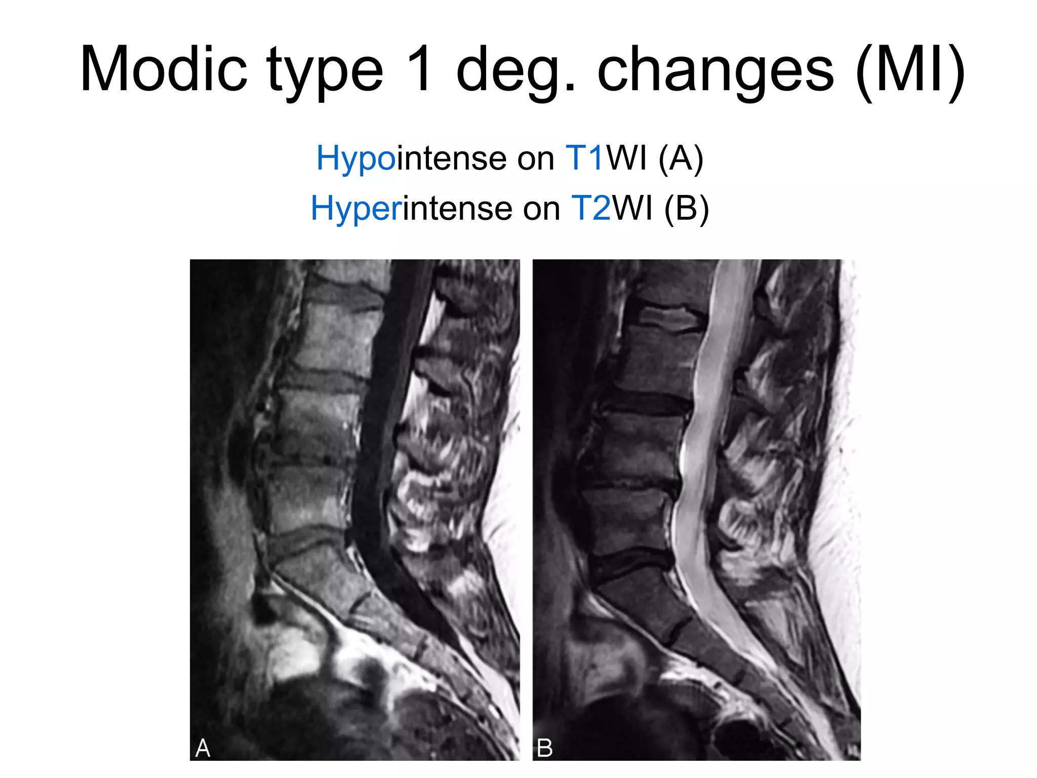 Modic type 1 deg. changes (MI) 
Hypointense on T1WI (A) 
Hyperintense on T2WI (B) 
 