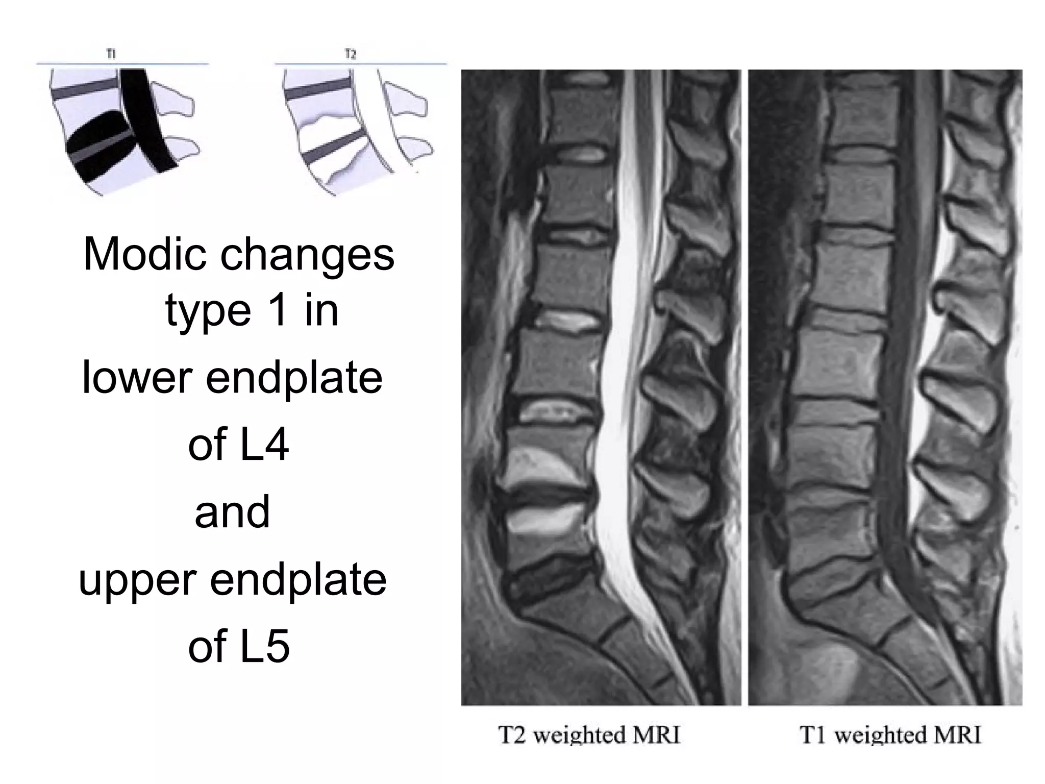 Modic changes 
type 1 in 
lower endplate 
of L4 
and 
upper endplate 
of L5 
 