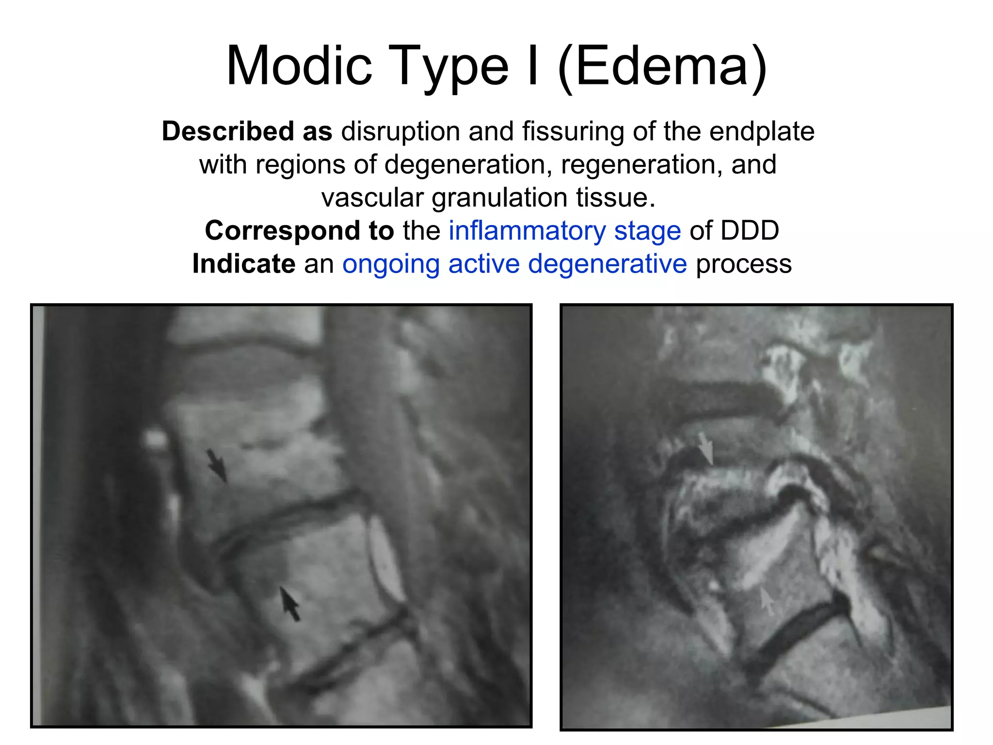 Modic Type I (Edema) 
Described as disruption and fissuring of the endplate 
with regions of degeneration, regeneration, and 
vascular granulation tissue. 
Correspond to the inflammatory stage of DDD 
Indicate an ongoing active degenerative process 
 